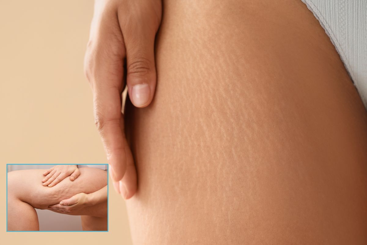 How to Get Rid of Cellulite on Legs