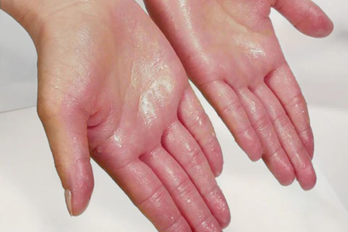 Sweaty Hands