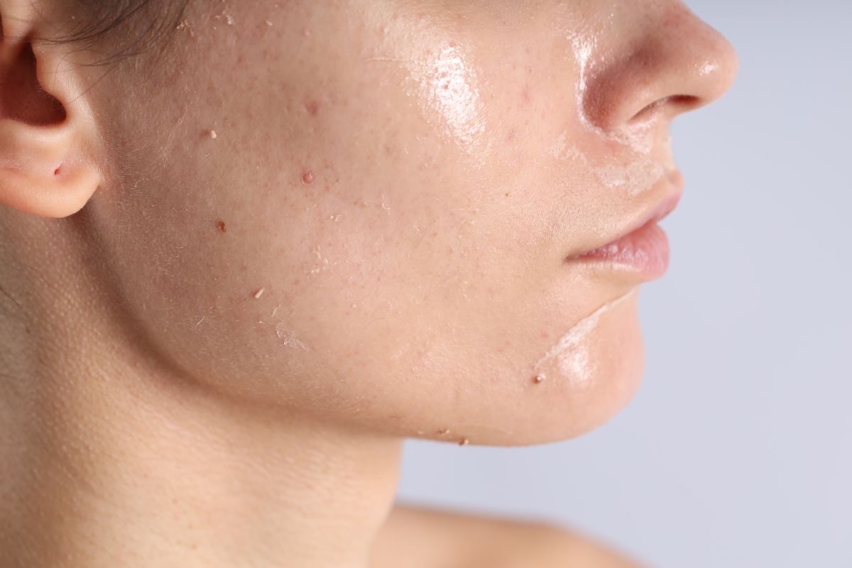 Why Oily Skin Can Still Feel Thirsty