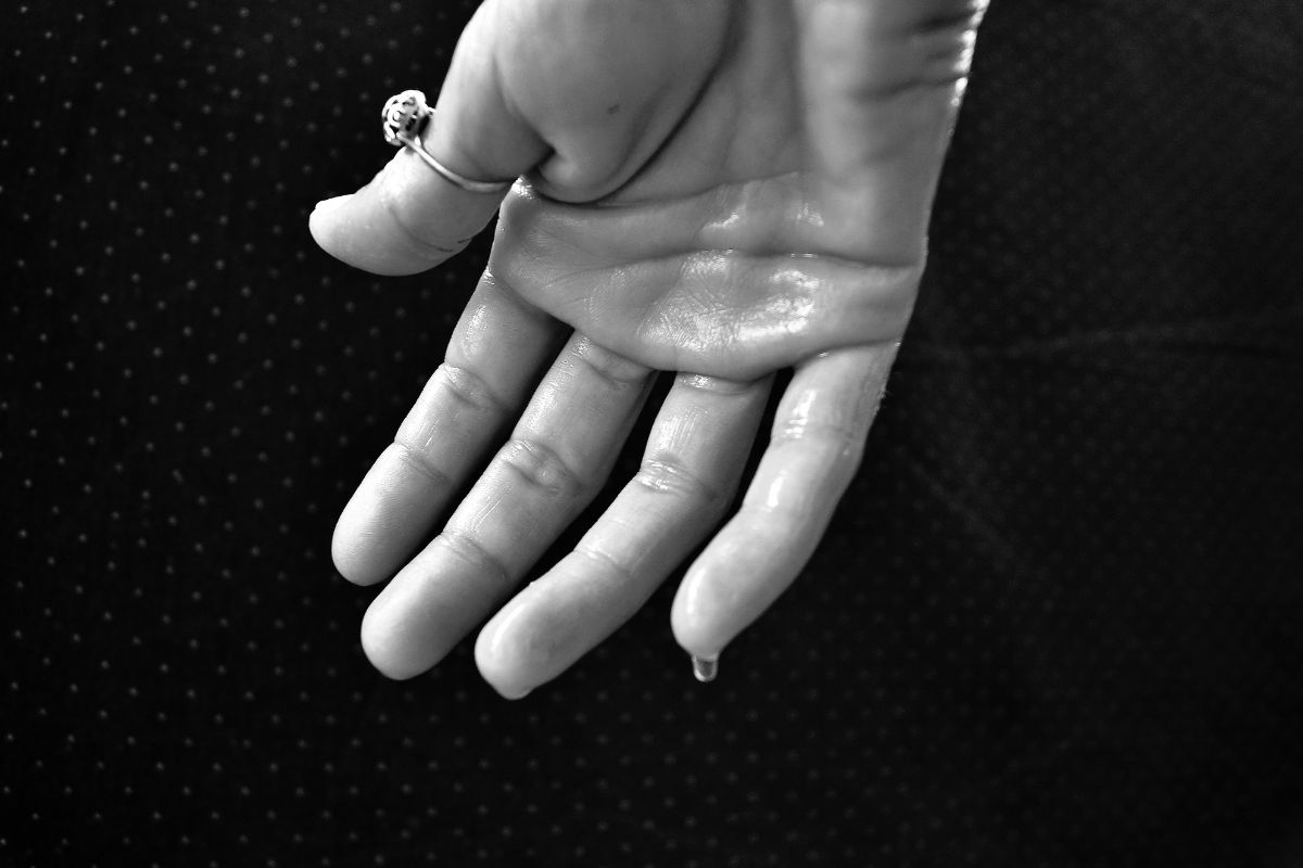 hyperhidrosis